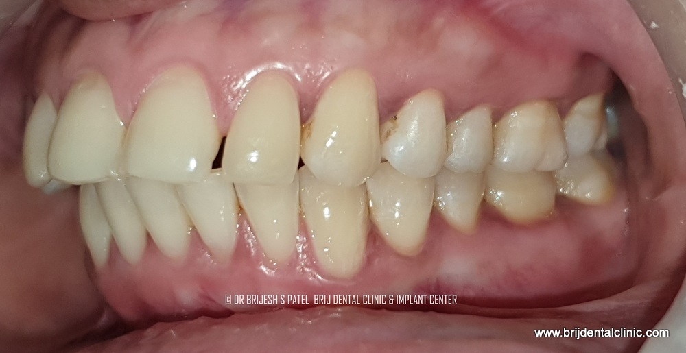 Before treatment Proclined and gap teeth lt side