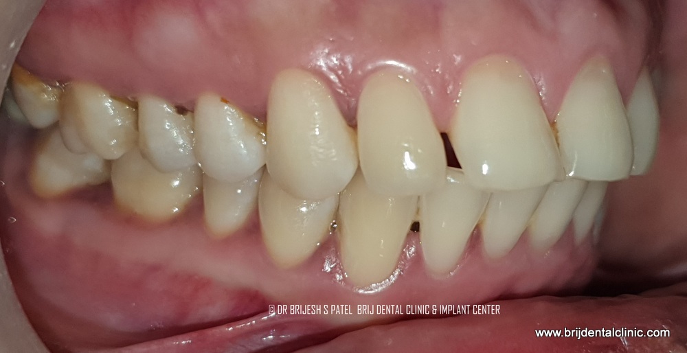 Before treatment Proclined and gap teeth rt side
