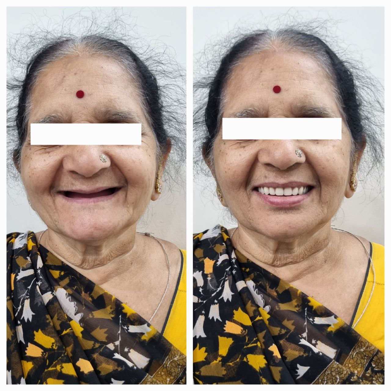 AFTER REHABILITATION WITH IMPLANT OVERDENTURE