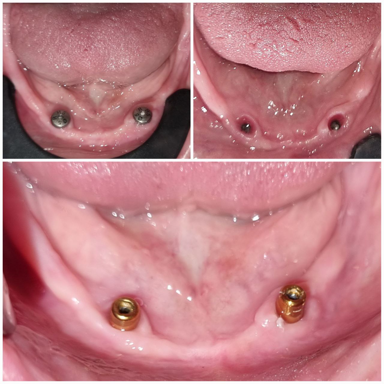 IMPLANT OVERDENTURE WITH TWO IMPLANTS
