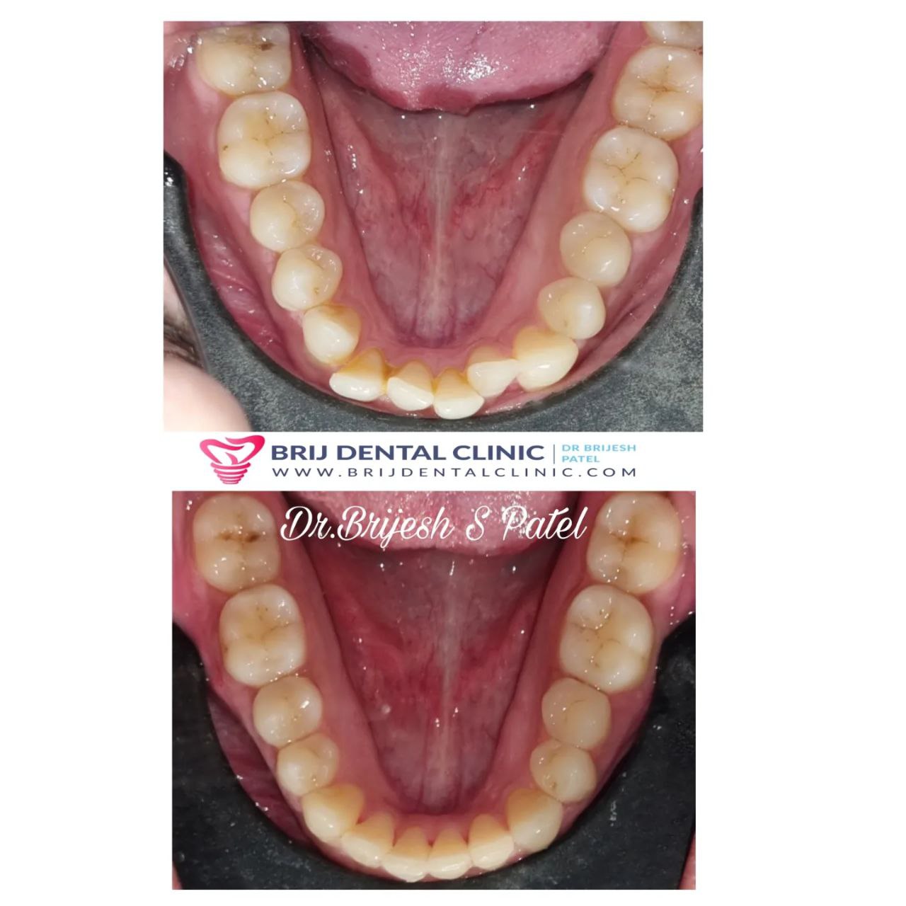 Lower jaw crowding before after with best invisible clearcorrect aligners in ahmedabad